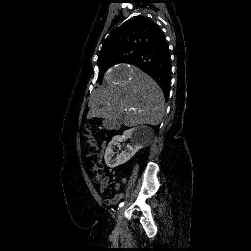 Aortic dissection - Stanford type B (Radiopaedia 88281-104910 C 22).jpg