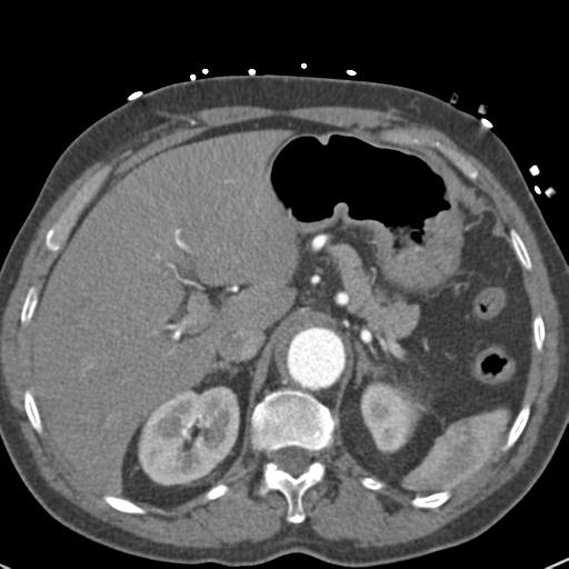 Aortic intramural hematoma (Radiopaedia 31139-31838 B 85).jpg