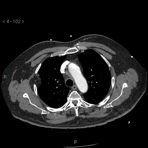 File:Aortic intramural hematoma (Radiopaedia 48463-53380 B 46).jpg