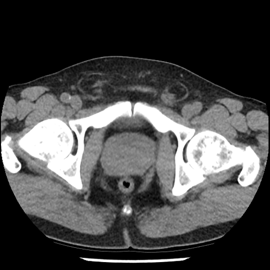 Aortic intramural hematoma (type B) (Radiopaedia 79323-92387 Axial non-contrast 113).jpg