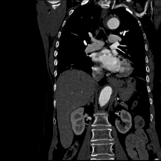 Aortic intramural hematoma from penetrating atherosclerotic ulcer (Radiopaedia 31137-31836 C 35).jpg