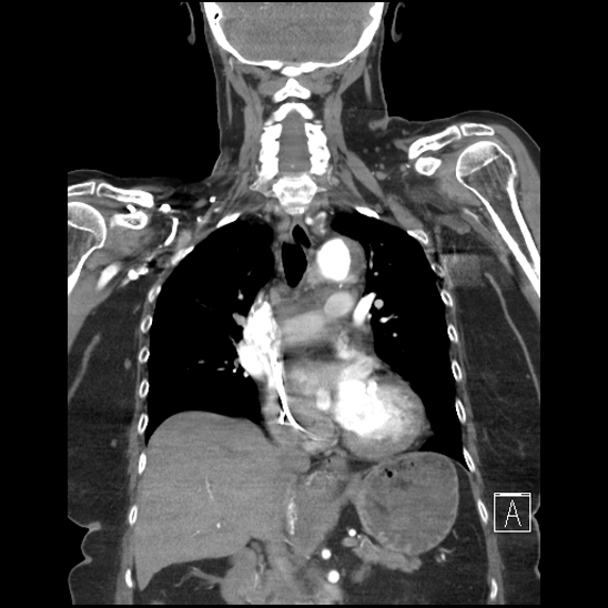 File:Aortic intramural hematoma with dissection and intramural blood pool (Radiopaedia 77373-89491 C 30).jpg