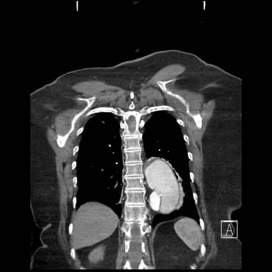 Aortic intramural hematoma with dissection and intramural blood pool (Radiopaedia 77373-89491 C 53).jpg