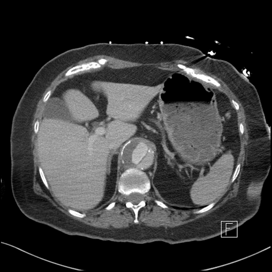 File:Aortic intramural hematoma with dissection and intramural blood pool (Radiopaedia 77373-89491 E 8).jpg