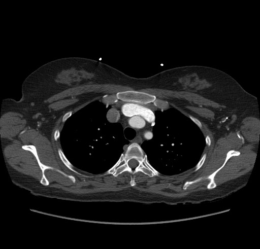 Aortic nipple (Radiopaedia 63008-71449 B 25).jpg