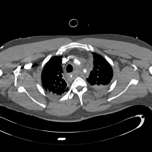 Aortic transection, diaphragmatic rupture and hemoperitoneum in a complex multitrauma patient (Radiopaedia 31701-32622 A 23).jpg