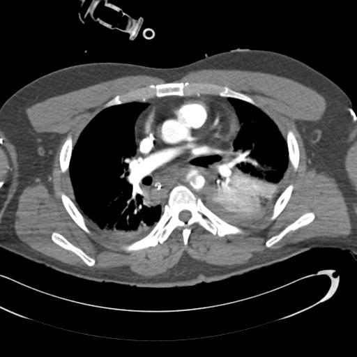 Aortic transection, diaphragmatic rupture and hemoperitoneum in a complex multitrauma patient (Radiopaedia 31701-32622 A 41).jpg