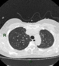 File:Aortic valve endocarditis (Radiopaedia 87209-103485 Axial lung window 28).jpg