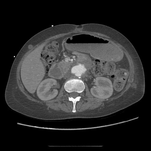 Aorto-duodenal fistula (Radiopaedia 25668-25850 A 30).jpg