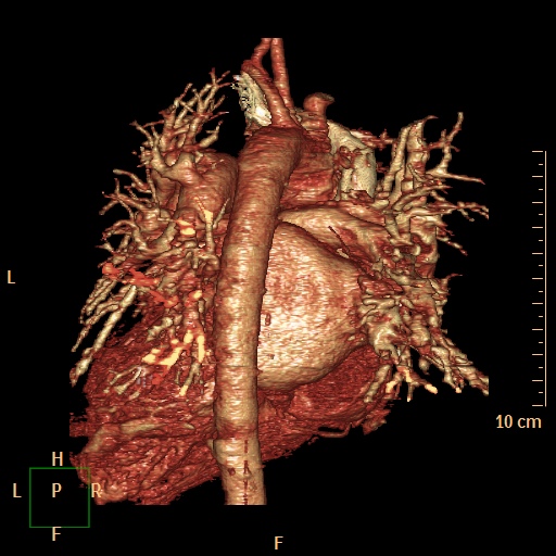 File:Aortopulmonary septal defect (Radiopaedia 41990-45013 3D reconstruction 11).jpg