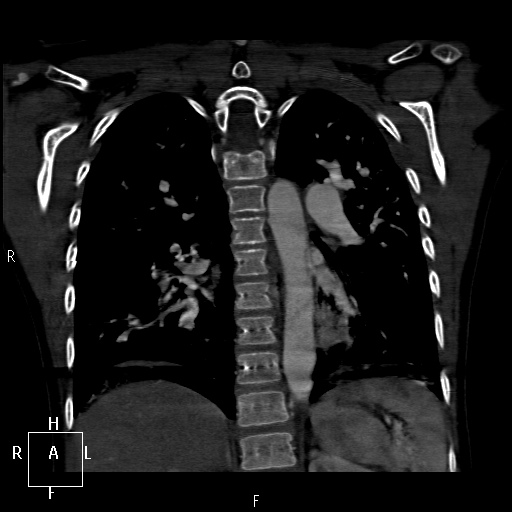 File:Aortopulmonary septal defect (Radiopaedia 41990-45013 Coronal C+ CTPA 48).jpg