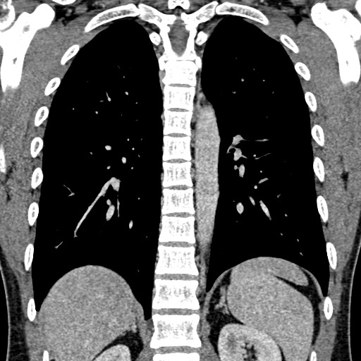 Apical lung mass mimic - neurogenic tumor (Radiopaedia 59918-67521 B 76).jpg