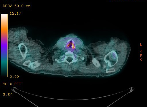 Appendiceal adenocarcinoma complicated by retroperitoneal abscess (Radiopaedia 58007-65041 Axial PET-CT 25).jpg