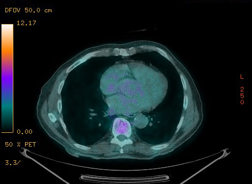 Appendiceal adenocarcinoma complicated by retroperitoneal abscess (Radiopaedia 58007-65041 Axial PET-CT 79).jpg