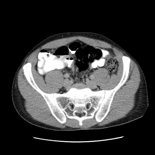 File:Appendicitis complicated by post-operative collection (Radiopaedia 35595-37113 A 56).jpg