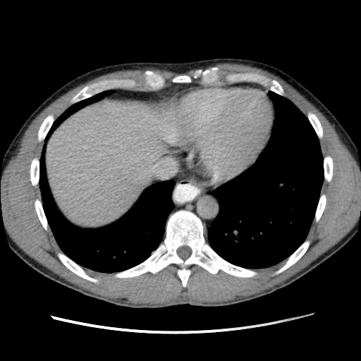 File:Appendicitis complicated by post-operative collection (Radiopaedia 35595-37114 A 10).jpg