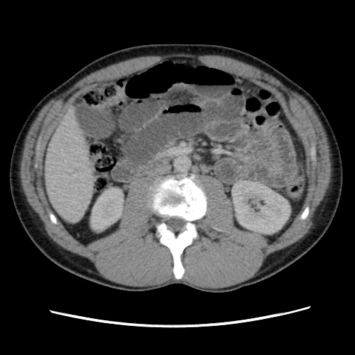 Appendicitis complicated by post-operative collection (Radiopaedia 35595-37114 A 39).jpg