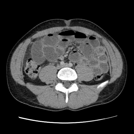 Appendicitis complicated by post-operative collection (Radiopaedia 35595-37114 A 52).jpg