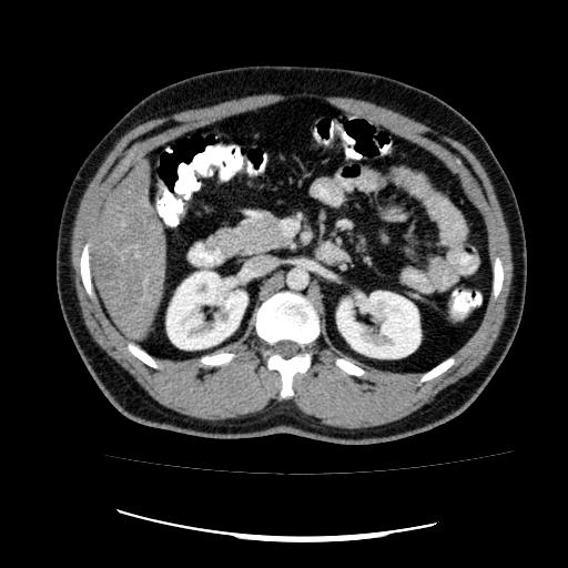 File:Appendicitis with diverticulosis (Radiopaedia 47693-52383 Axial C+ 51).jpg