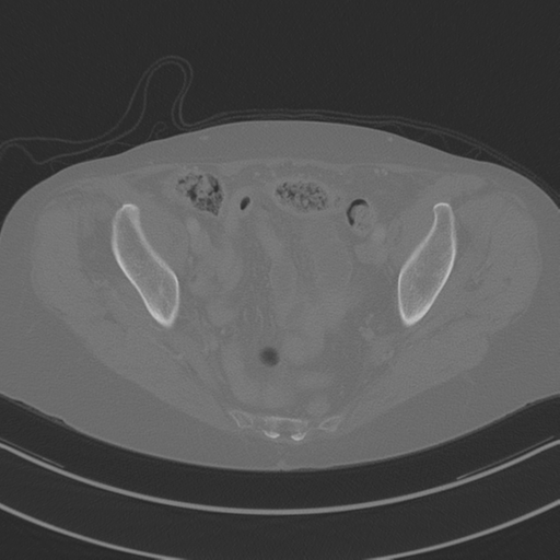 April fools' 2019- calcified peritoneal arachnoidosis (Radiopaedia 67273-76636 Axial bone window 46).png