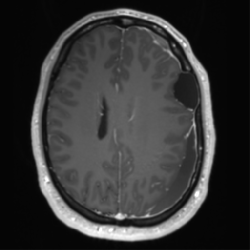 File:Arachnoid cyst with subdural hematoma (Radiopaedia 85892-101743 Axial T1 C+ 56).png
