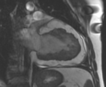 Arrhythmogenic right ventricular cardiomyopathy (Radiopaedia 69431-79307 2ch cine 27).jpg