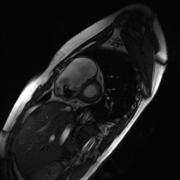 Arrhythmogenic right ventricular cardiomyopathy (Radiopaedia 87505-103850 short axis Cine SSFP 188).jpg