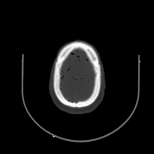 Arrow injury to the brain (Radiopaedia 72101-82607 Axial bone window 89).jpg