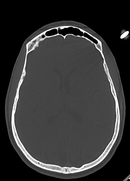 Arrow injury to the head (Radiopaedia 75266-86388 Axial bone window 78).jpg