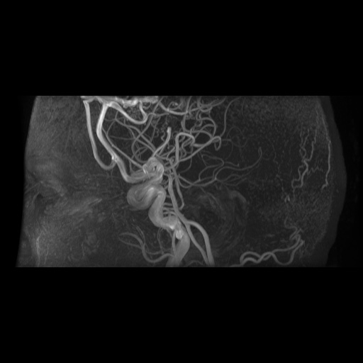 Arteriovenous malformation (Radiopaedia 71628-81999 Axial MRA 2).jpg