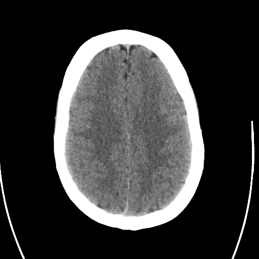 File:Arteriovenous malformation (cerebral) (Radiopaedia 40070-42579 Axial non-contrast 23).png