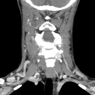 File:Arteriovenous malformation of the neck (Radiopaedia 53935-60062 D 13).jpg