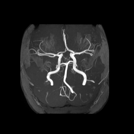 Artery of Percheron infarct (Radiopaedia 40966-43676 F 14).jpg