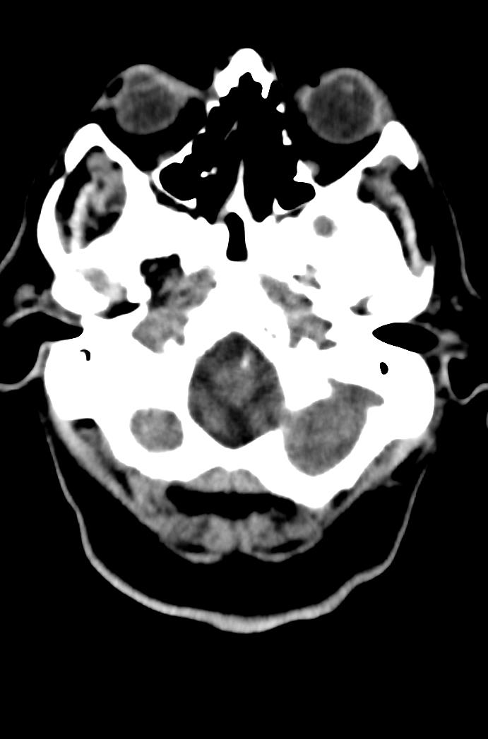 Artery of Percheron infarction (Radiopaedia 80613-94202 Axial non-contrast 35).jpg
