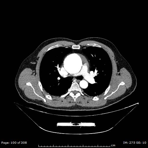 Ascending aortic aneurysm (Radiopaedia 50086-55404 A 28).jpg