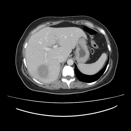 File:Ascending retrocecal appendicitis with liver abscesses (Radiopaedia 60066-67615 B 21).jpg