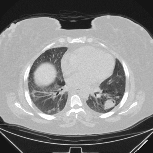 Aspergilloma (Radiopaedia 39611-41932 Axial lung window 74).jpg
