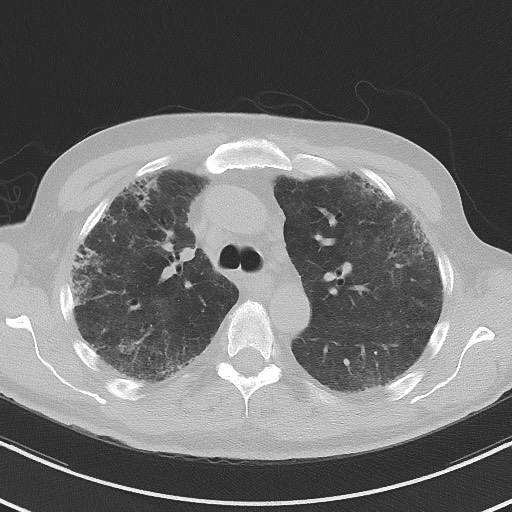 Aspergilloma on background pulmonary fibrosis (Radiopaedia 60942-68757 A 20).jpg