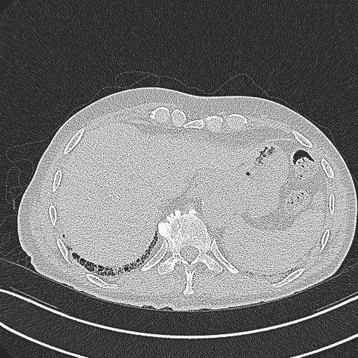 File:Aspergilloma on background pulmonary fibrosis (Radiopaedia 60942-68757 B 46).jpg