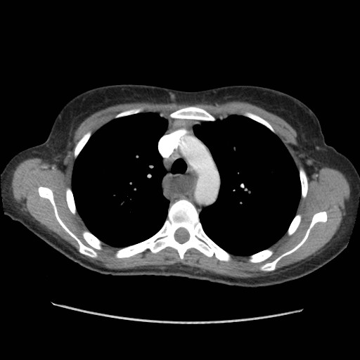 File:Aspiration pneumonia secondary to laparoscopic banding (Radiopaedia 18345-18183 A 14).jpg