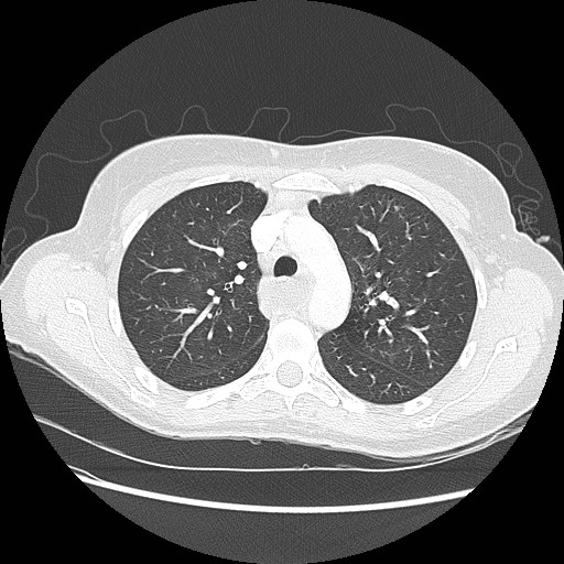 File:Aspiration pneumonia secondary to laparoscopic banding (Radiopaedia 18345-18183 lung window 32).jpg
