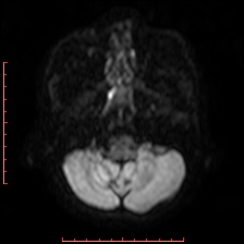 Astroblastoma (Radiopaedia 74287-85162 Axial DWI 14).jpg