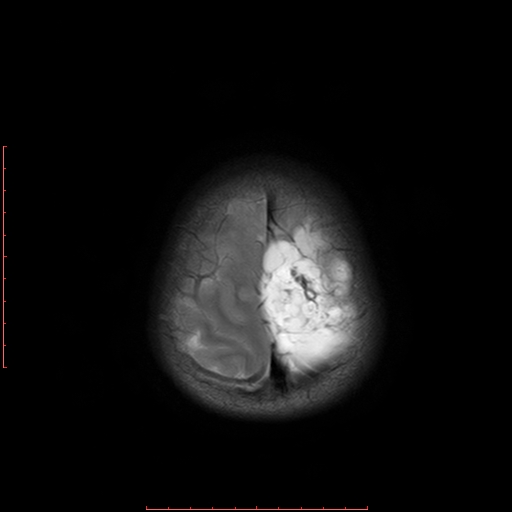 File:Astroblastoma (Radiopaedia 74287-85162 Axial T2 21).jpg