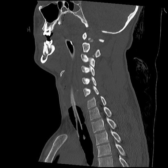 File:Atlanto-occipital dissociation (Traynelis type 1), C2 teardrop fracture, C6-7 facet joint dislocation (Radiopaedia 87655-104061 Sagittal bone window 32).jpg