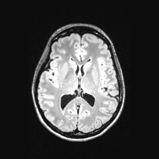 Atretic encephalocoele with inferior vermis hypoplasia (Radiopaedia 30443-31108 Axial 87).jpg