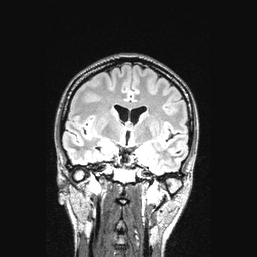 File:Atretic encephalocoele with inferior vermis hypoplasia (Radiopaedia 30443-31108 Coronal FLAIR 103).jpg