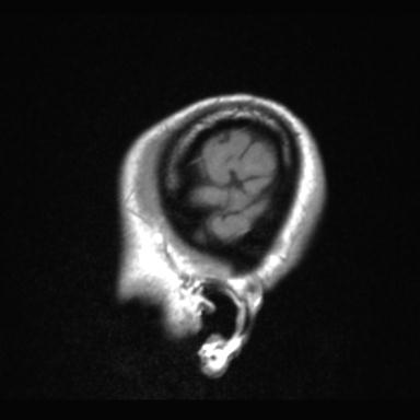 Atretic encephalocoele with inferior vermis hypoplasia (Radiopaedia 30443-31108 Sagittal T1 3).jpg