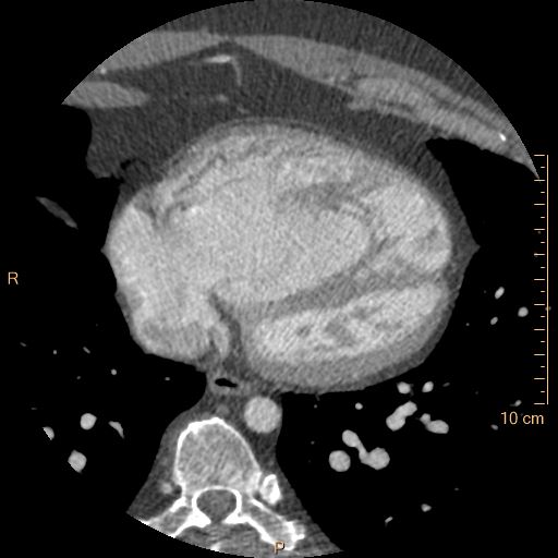 Atrial septal defect (upper sinus venosus type) with partial anomalous pulmonary venous return into superior vena cava (Radiopaedia 73228-83961 A 202).jpg