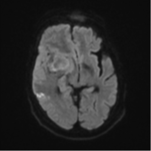 Atypical meningioma (WHO Grade II) (Radiopaedia 54742-60979 Axial DWI 41).png