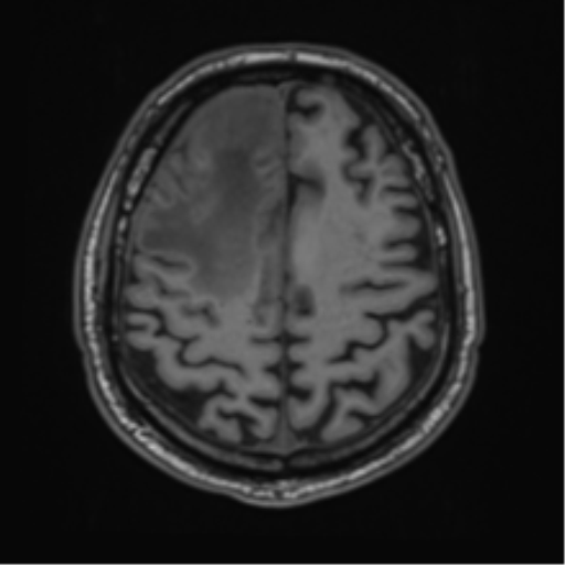 File:Atypical meningioma (WHO grade II) with brain invasion (Radiopaedia 57767-64729 Axial T1 39).png